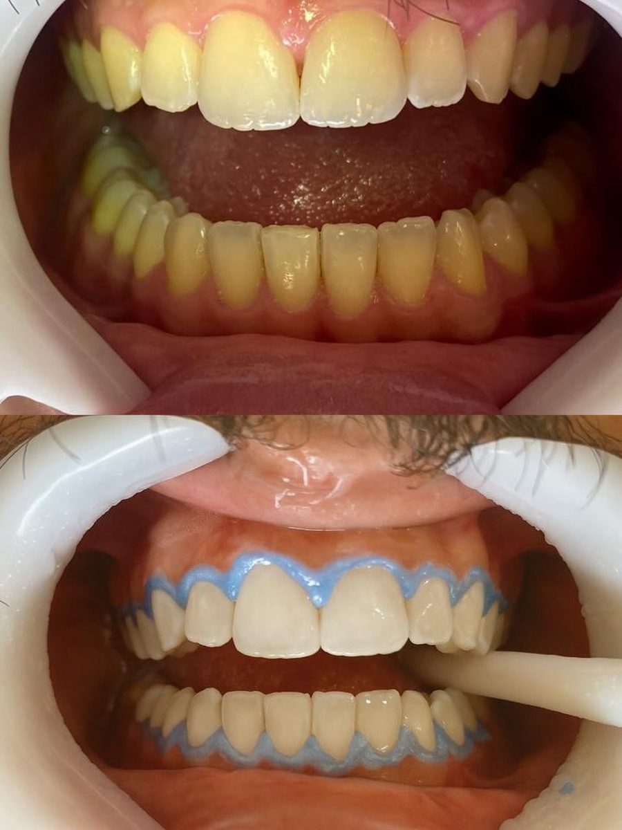 Antes e depois: clareamento dental deixando o sorriso mais branco