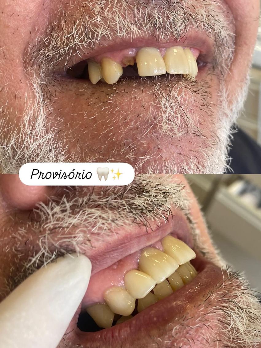 Antes e depois: reabilitação dos dentes com prótese provisória
